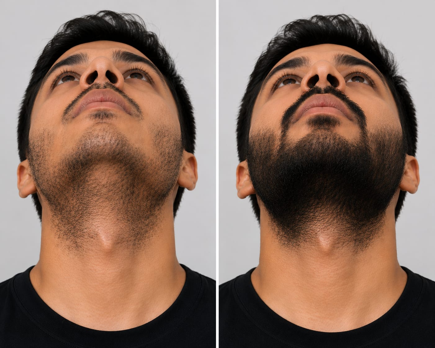 Beard Transplant Result